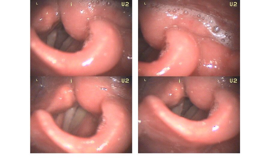 HAE — Hereditäres Angioödem